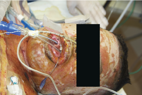 ATLS Airway Compromise