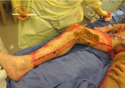 ATLS Escharotomy