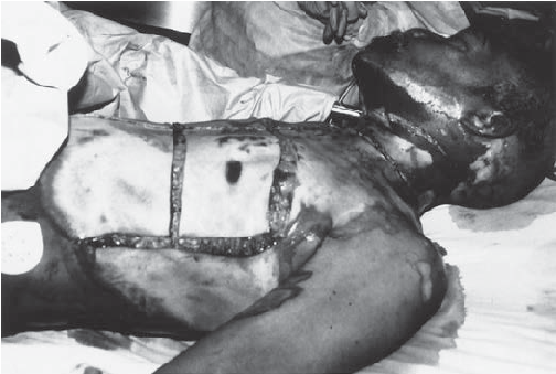 Chest Escharotomy