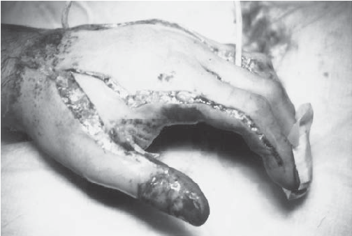 Hand Escharotomy